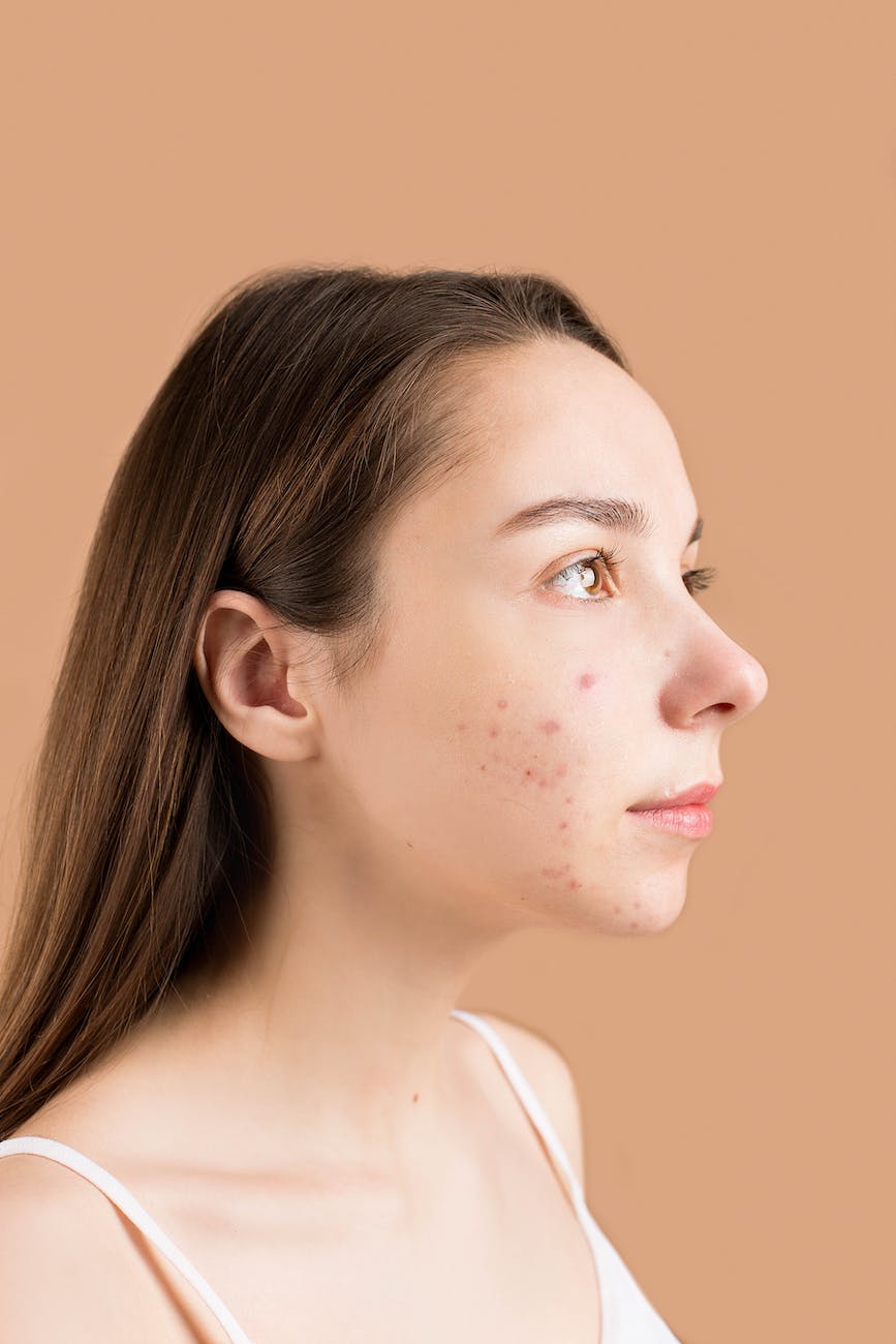 close up photo of a teenager with pimples on her face